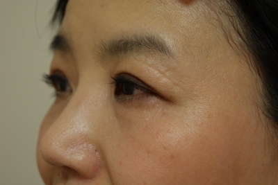 切らない眼瞼下垂と左目尻切開とプチアイリフトの１ヶ月後経過 美容のかかりつけ医を目指して