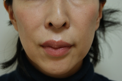 上唇小帯切除とスマイルセットの6ヶ月後経過 美容のかかりつけ医を目指して