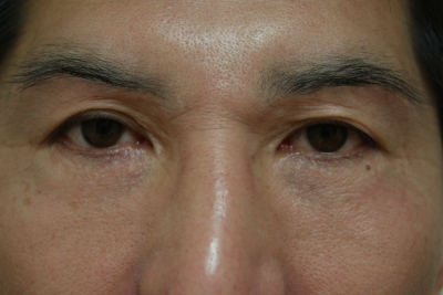 目尻切開の２ヶ月後経過 美容のかかりつけ医を目指して