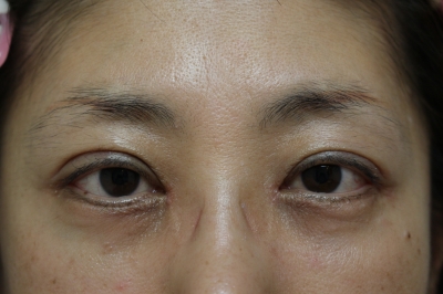 目頭目尻切開の1ヶ月後経過 美容のかかりつけ医を目指して