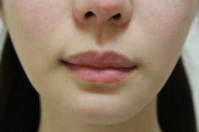 上下の唇を薄くする手術の再手術後１ヶ月後経過 美容のかかりつけ医を目指して