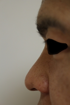 男性の鼻へのヒアルロン酸注入 美容のかかりつけ医を目指して