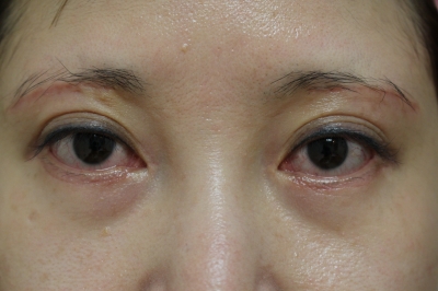 眉毛下切開とハムラ法の１ヶ月後までの経過 美容のかかりつけ医を目指して