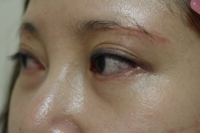 眉毛下切開とハムラ法の１ヶ月後までの経過 美容のかかりつけ医を目指して