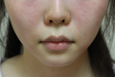 鼻の下は短い方が可愛い リップリフトの1ヶ月後経過 美容のかかりつけ医を目指して 鼻の下は短い方が可愛い リップリフトの1ヶ月後経過 美容のかかりつけ医を目指して