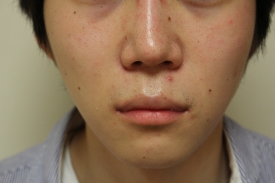 男性も顎を前に出すと格好良くなりますよ 美容のかかりつけ医を目指して