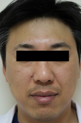 男性の顎へのヒアルロン酸注入 美容のかかりつけ医を目指して