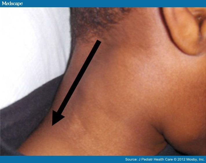 Enlarged cervical and submandibular lymph.
