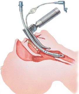 「intubation」の画像検索結果