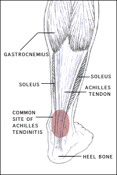 Achilles Tendon