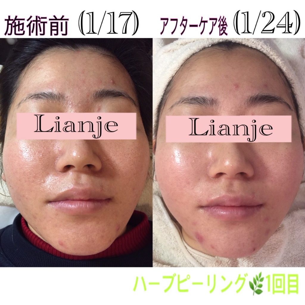 ハーブピーリングbeforeafter Lianje Waxのブログ