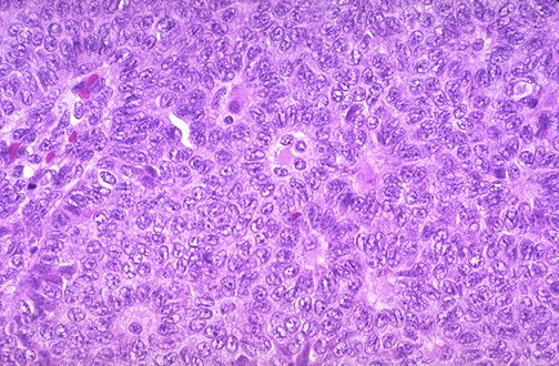 Granulosa Cell Tumor - Ovarian Cancer.