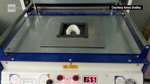 3Dプリンターを使って自分の歯を矯正08