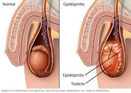 Epididymitis