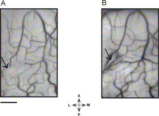 Getting a seton - can anyone explain?.