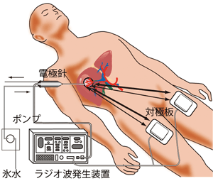 ラジオ波焼灼術イメージ