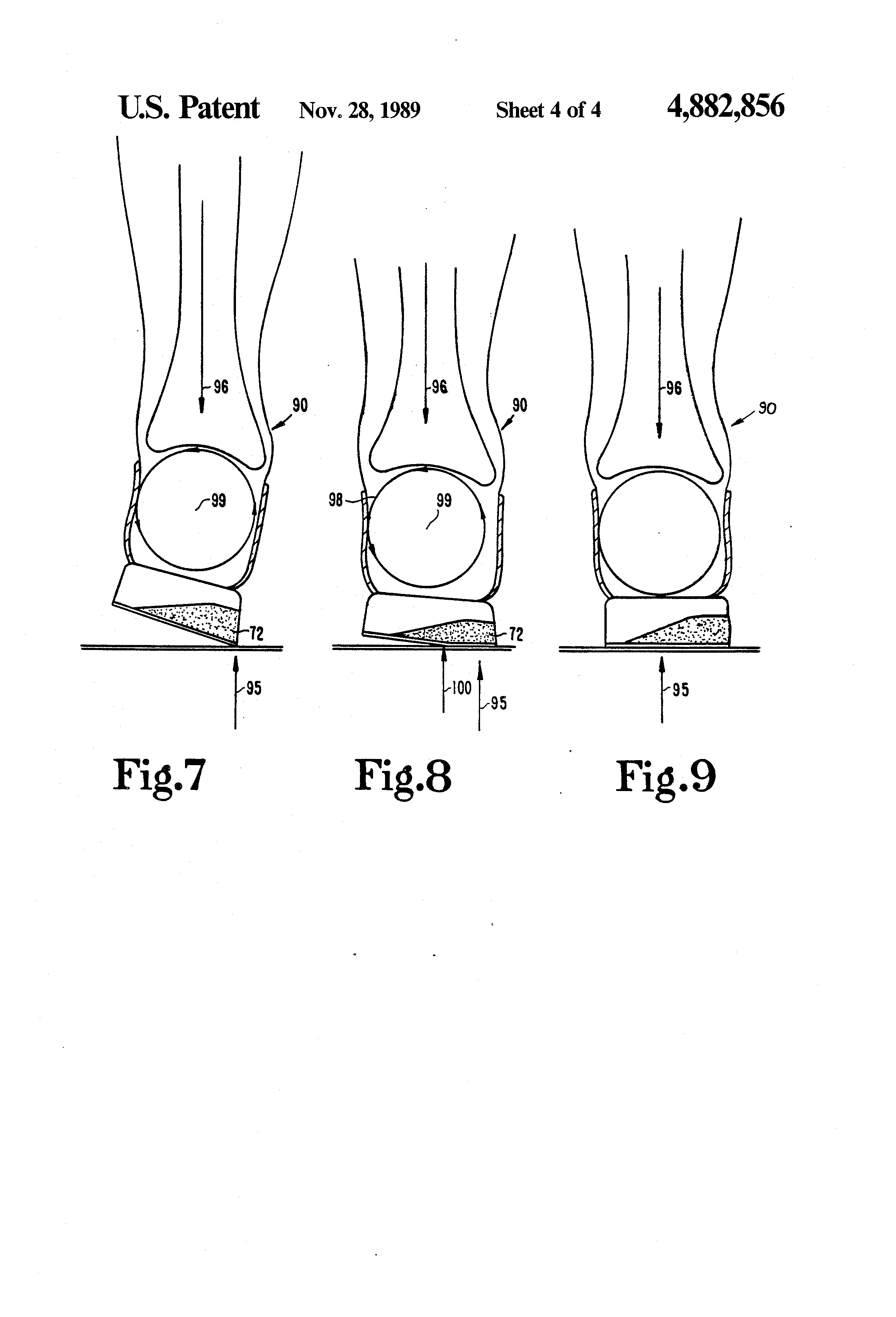 Hammer Toe