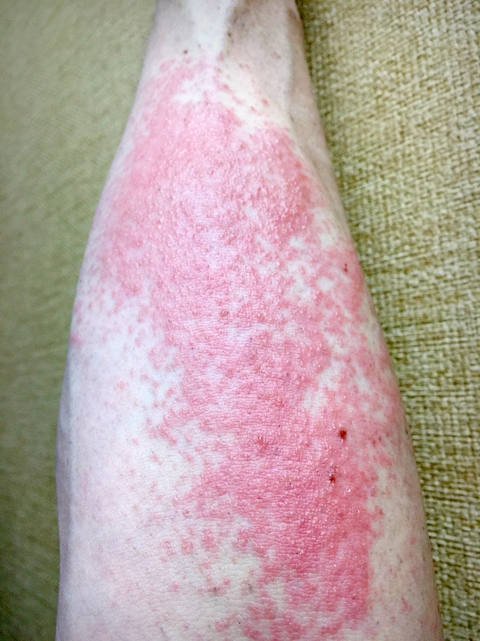 16 5 漆かぶれ まっきぃ の ひとりごと
