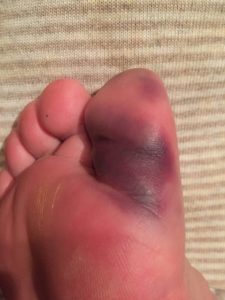 打撲にはこれ 東京目黒 薬膳 ヨガとセルフメディケーションと 天野賀恵子