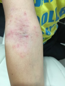 子供の湿疹に 水素水を湿布してみました Sorriso ソリッソ のブログ