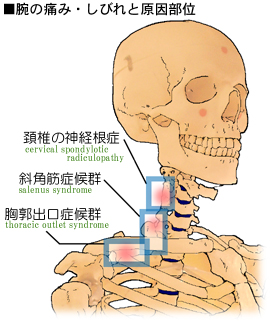 腕の痛みの発生部位と分類、胸郭出口症候群、斜角筋症候群、頚椎の神経根症