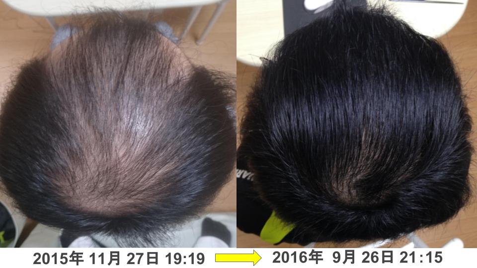 頭頂部の発毛・育毛改善例