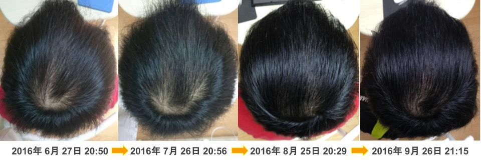 頭頂部の発毛・育毛改善例