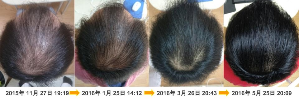 頭頂部の発毛・育毛改善例