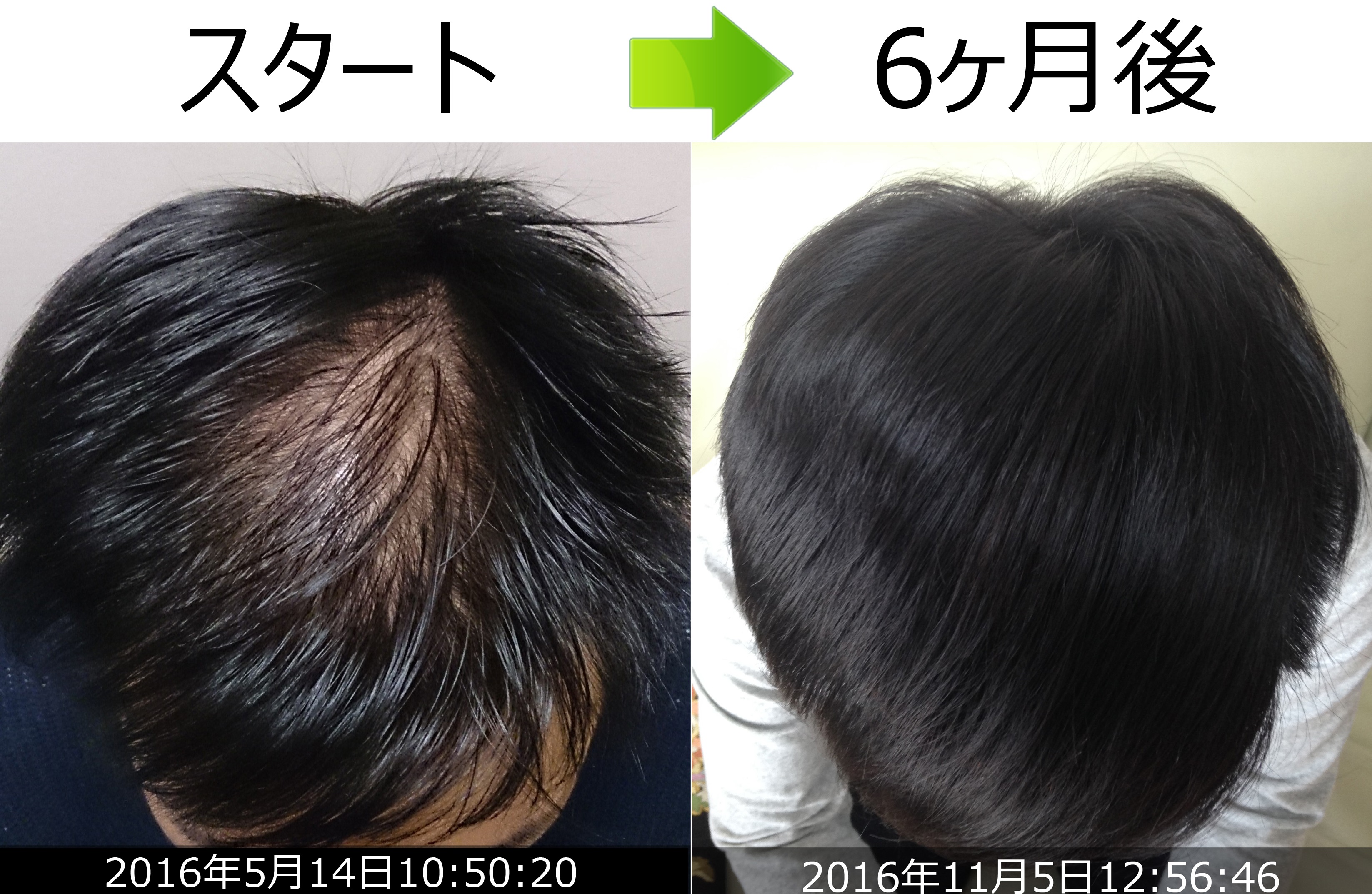 30代男性男性型脱毛症改善例