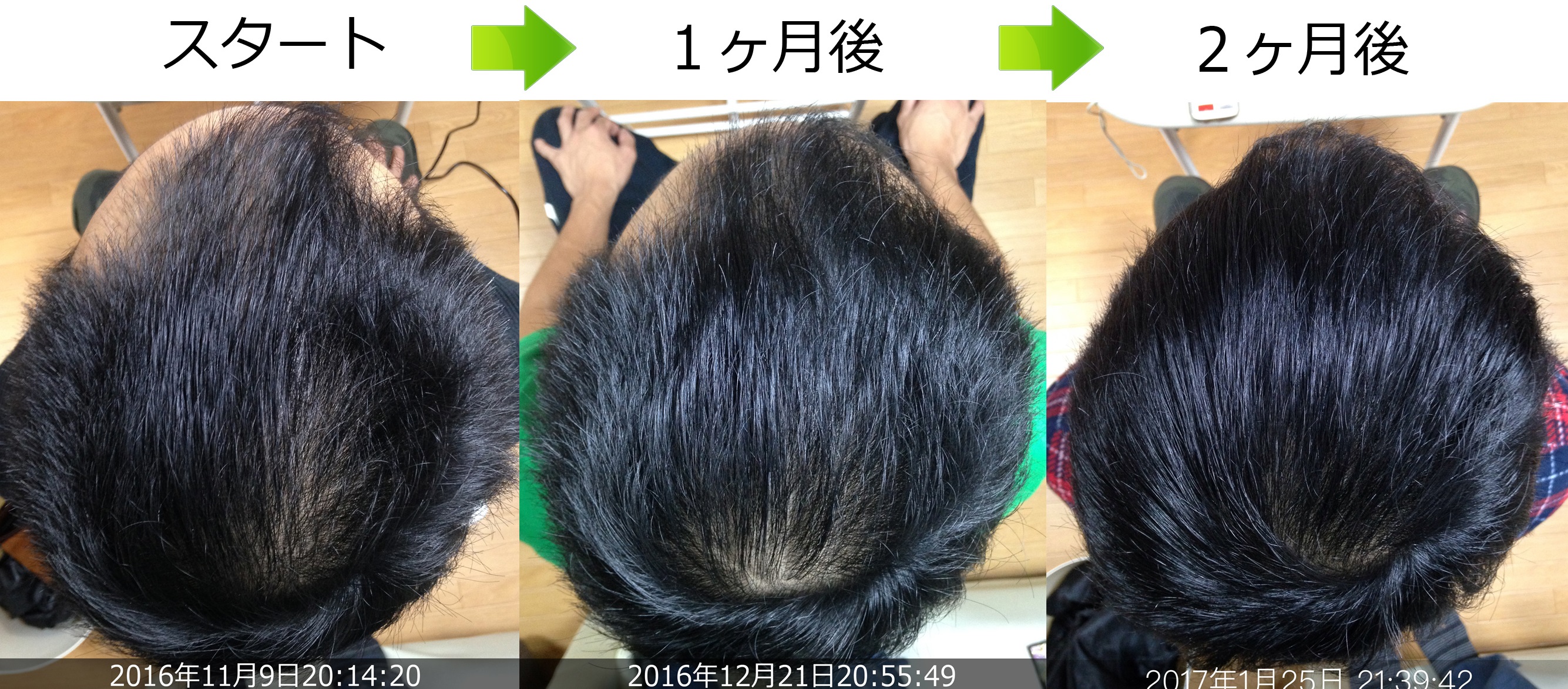 頭頂部のAGA治療アンケート