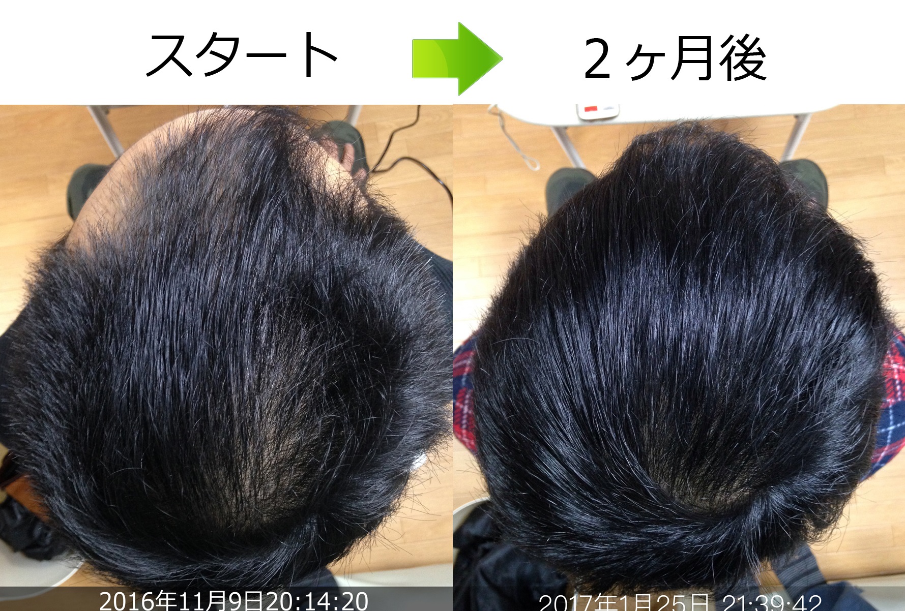 頭頂部のAGA治療