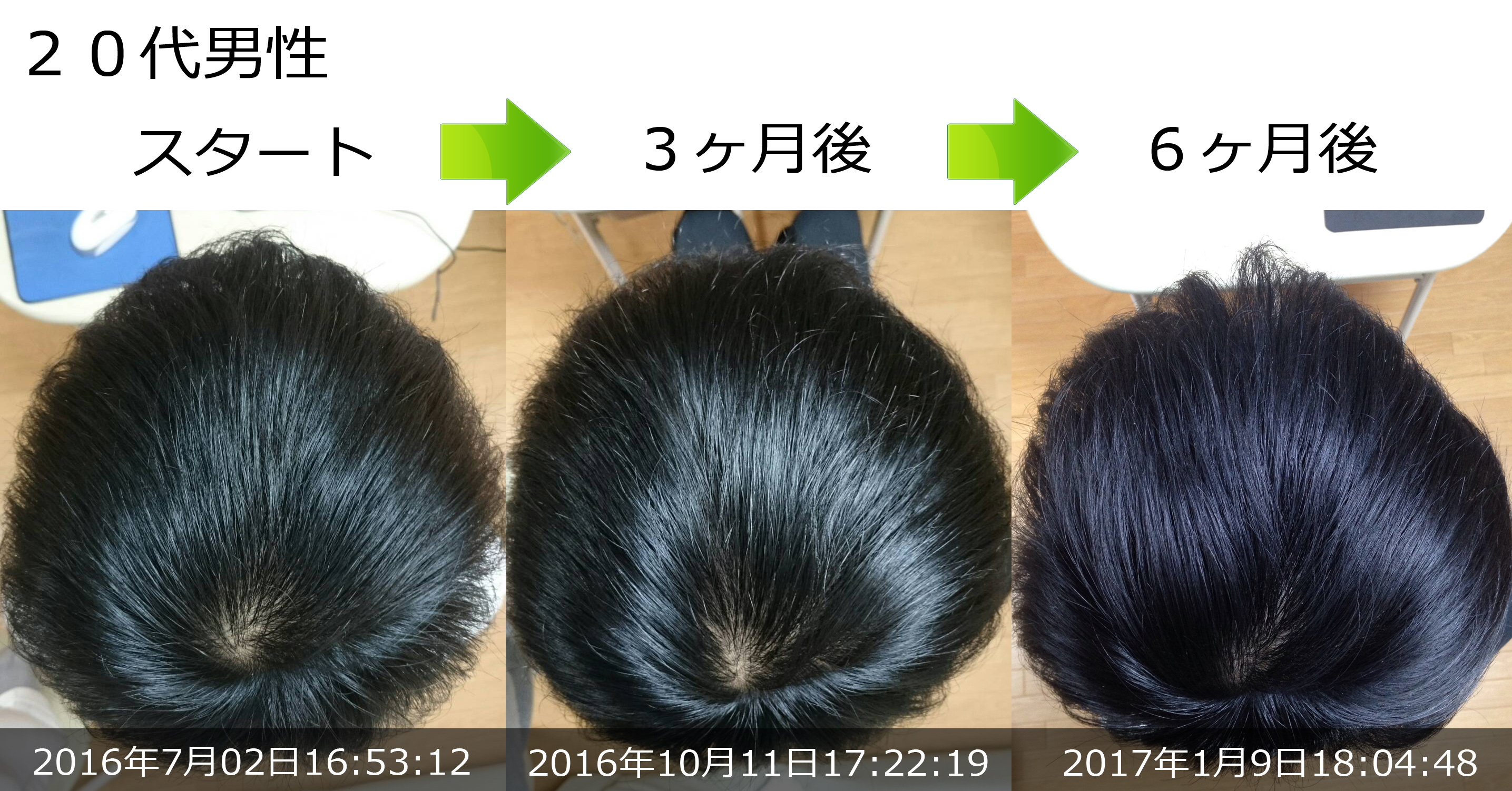 頭頂部の薄毛治療実績