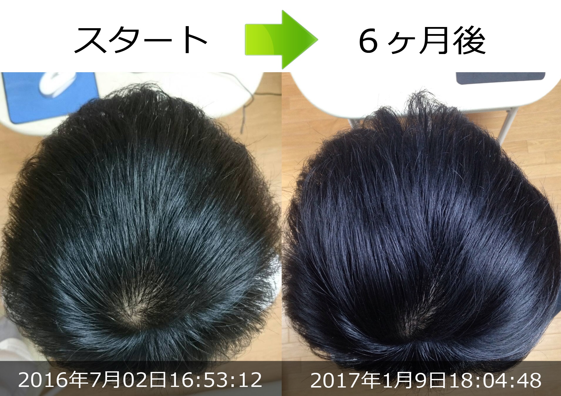 頭頂部抜け毛改善実績