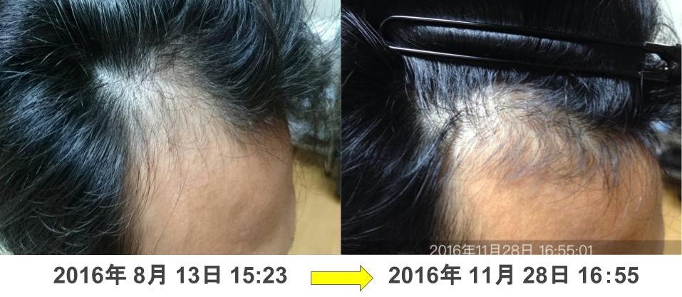 M字の薄毛治療実績