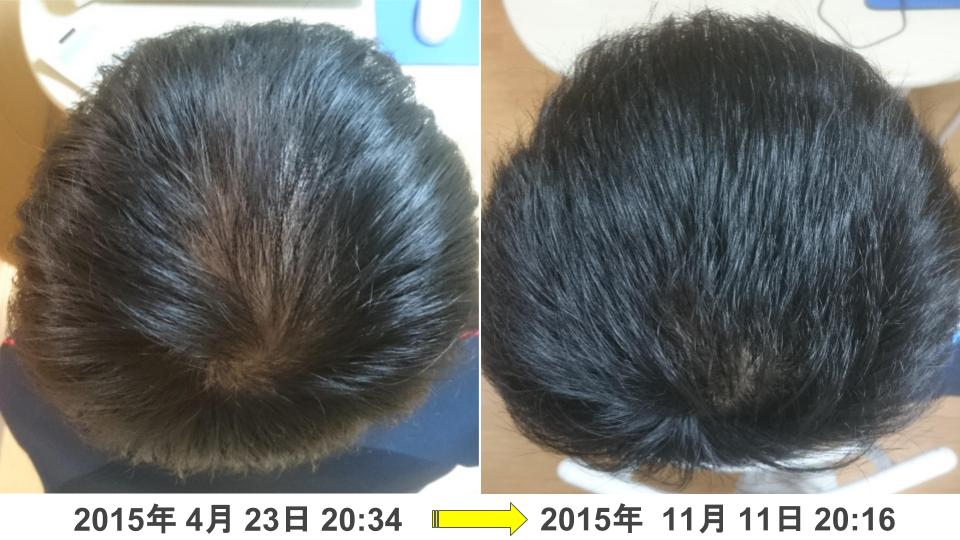 頭頂部のAGA治療実績