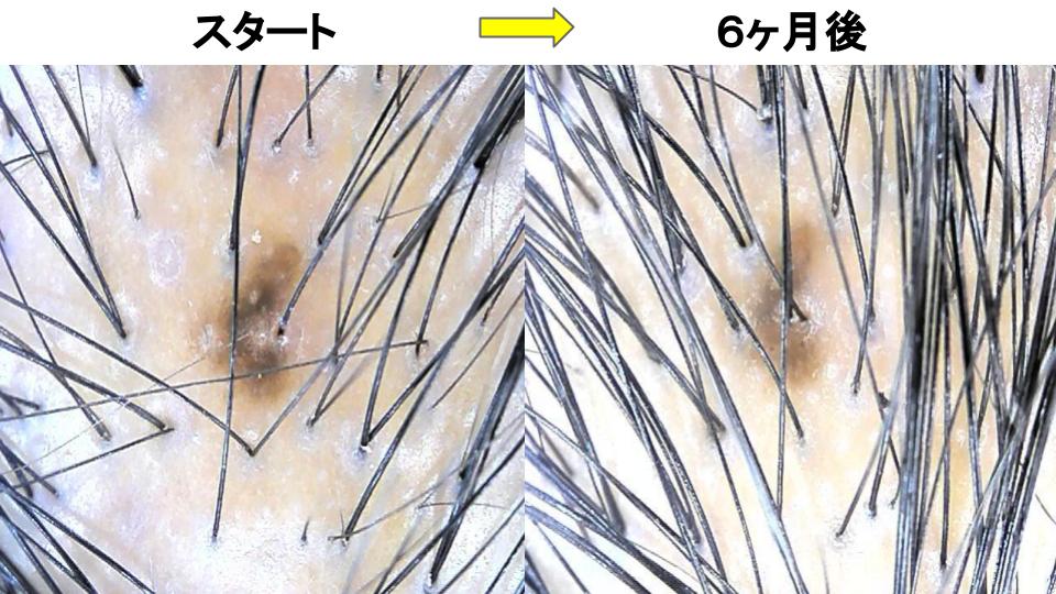 頭頂部のAGA治療実績