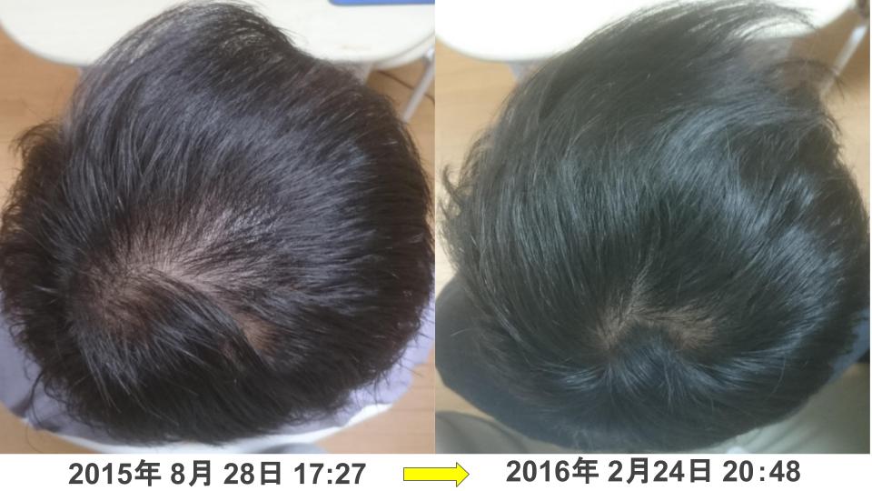 30代男性男性型脱毛症改善例