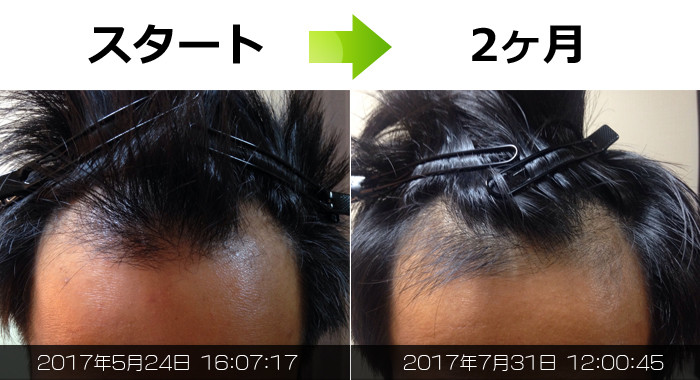 生え際・M字の発毛実績