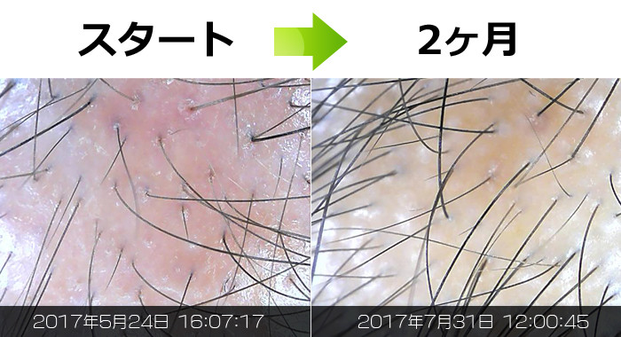 生え際・M字の発毛実績アンケート