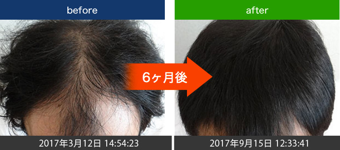 頭頂部・生え際の発毛と育毛実績