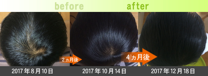 頭頂部の発毛・育毛実績