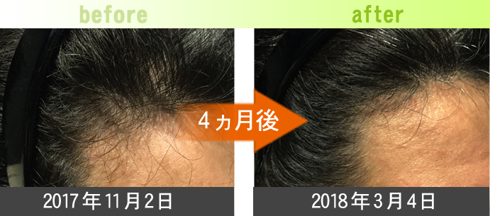 30代男性つむじ周りの発毛改善例