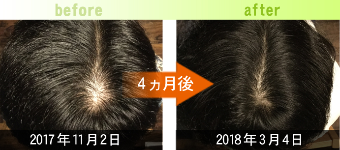 30代男性つむじ周りの発毛改善例