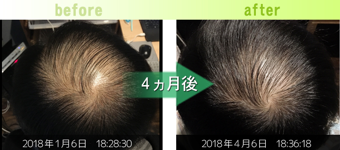 30男性つむじ周りＡＧＡ治療発毛経過