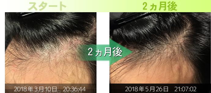 20代男性M字の薄毛治療に成功