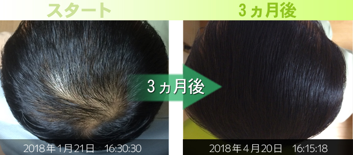 30代男性頭頂部発毛経過