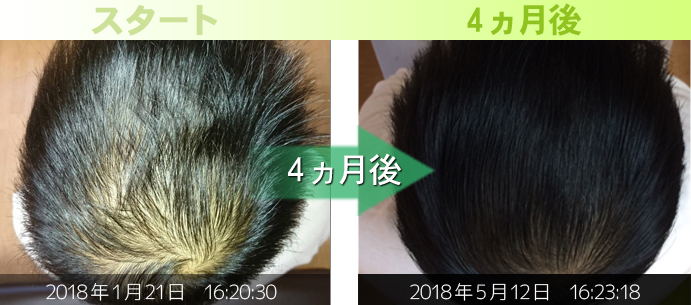頭頂部の薄毛治療写真