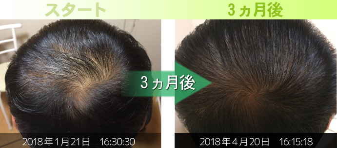 30代男性頭頂部発毛経過