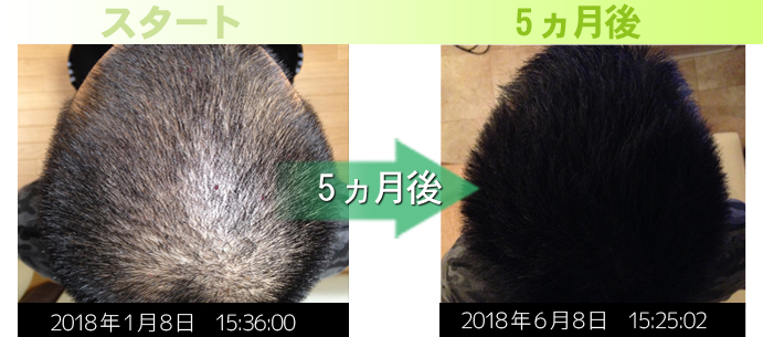 頭頂部のAGA治療実績