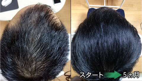 熊本AGA治療発毛実績